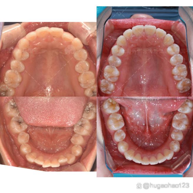 矫正牙齿时舌头太长，会影响矫正效果吗？-图3