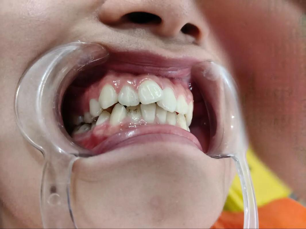 新加坡眼视角，牙齿矫正有哪些独特优势值得关注？-图2