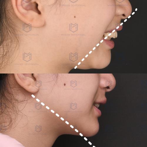 牙齿矫正真的会导致下巴变短吗？原因是什么？-图1