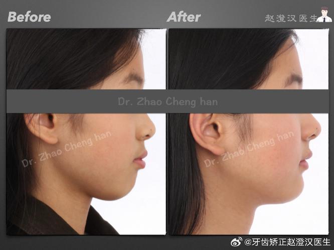 牙齿矫正真的会导致下巴变短吗？原因是什么？-图2