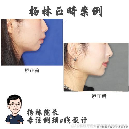 牙齿矫正真的会导致下巴变短吗？原因是什么？-图3