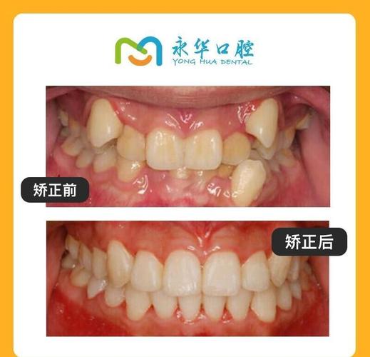 隐形矫正能改善虎牙吗？效果如何？-图3