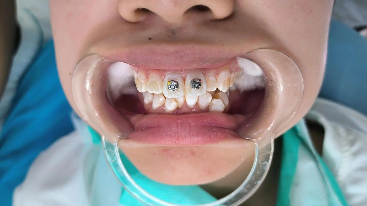 怀孕期间做牙齿正畸矫正安全吗？-图1