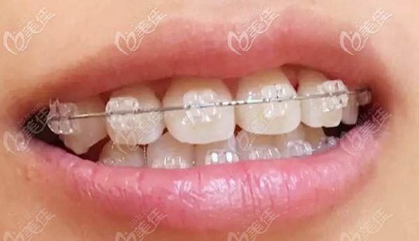 牙齿矫正用冰晶托槽效果真的更好吗？-图3