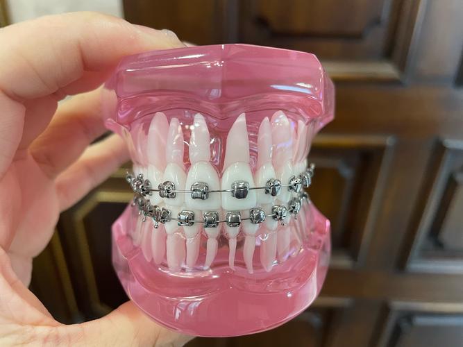 牙齿矫正用冰晶托槽效果真的更好吗？-图2