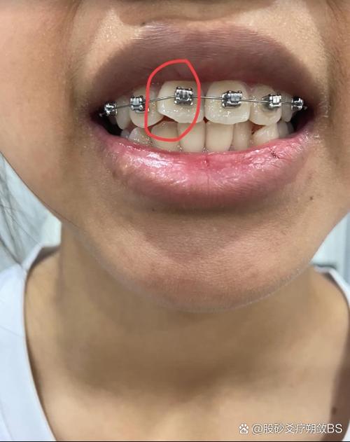 牙齿矫正后牙齿酸痛,是正常现象吗?怎么缓解?-图3 牙齿矫正后牙齿酸痛,是正常现象吗?怎么缓解?-图3