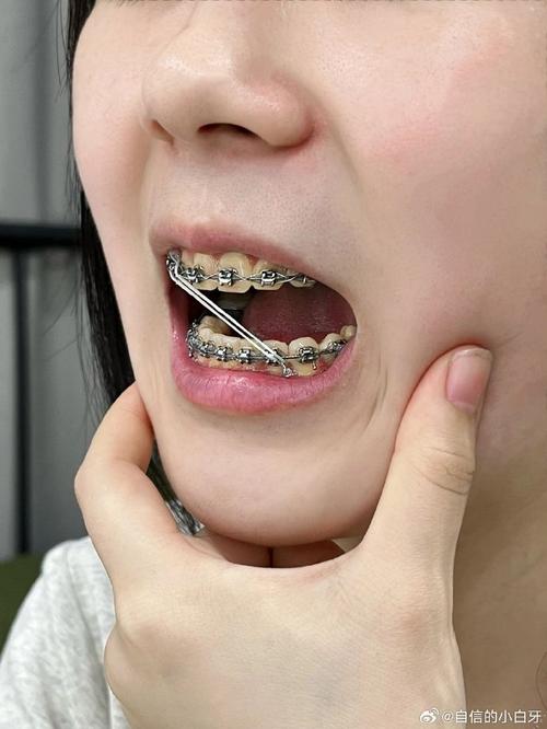 矫正牙齿为何会导致牙齿变黄？原因是什么？如何有效预防？-图2
