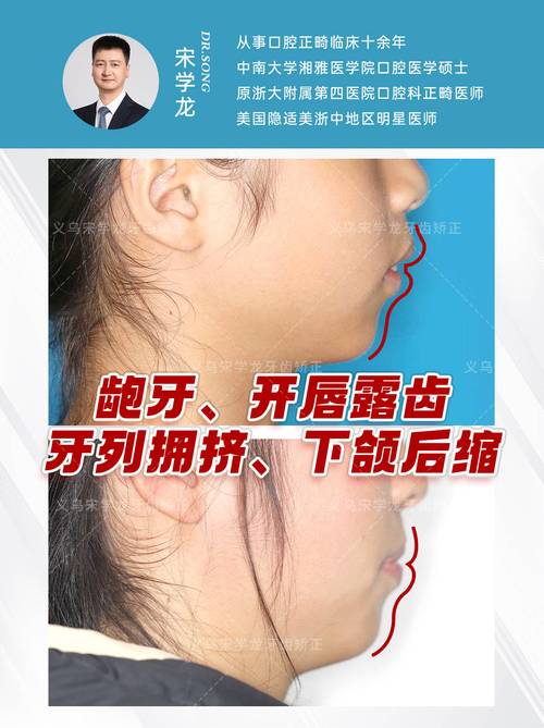 正颌矫正和牙齿矫正有何区别？如何选择？-图3