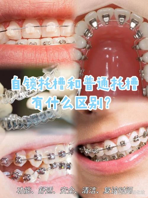 牙齿矫正器矫正牙齿的具体步骤和原理是什么？-图1