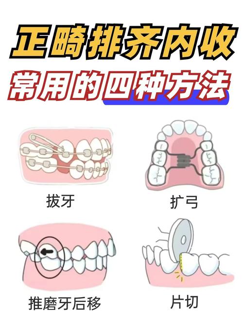 牙齿矫正器矫正牙齿的具体步骤和原理是什么？-图3