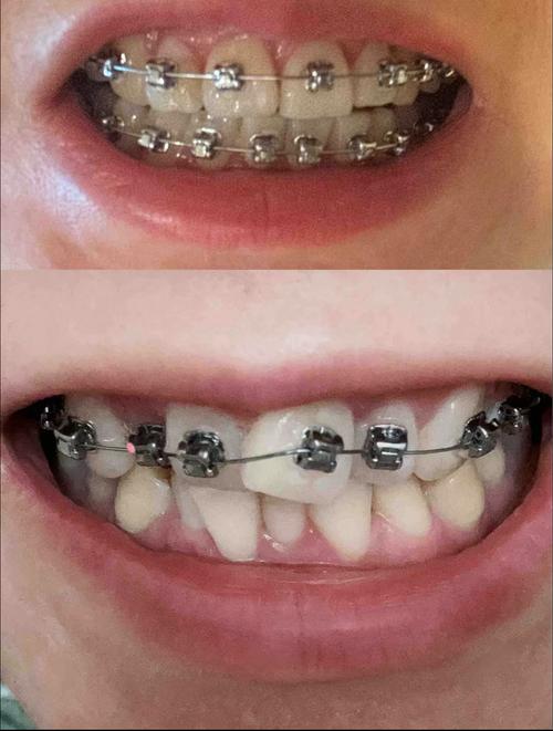 牙齿矫正期间牙齿变长，是什么原因导致的？是否属于正常现象？-图2