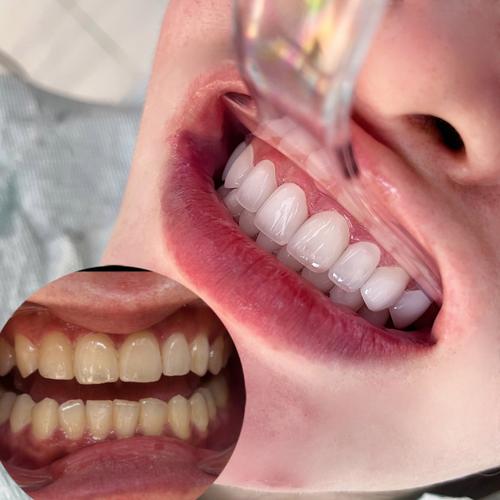 矫正牙齿和牙齿贴面-图2