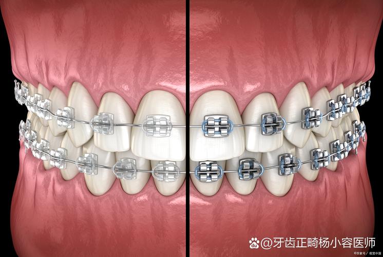 矫正时牙齿松动正常吗？原因及应对方法有哪些？-图2