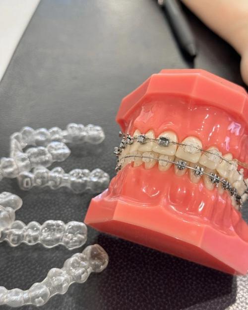 杭州牙齿矫正，效果价格哪家靠谱怎么选？-图3