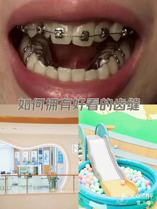 杭州牙齿矫正，效果价格哪家靠谱怎么选？-图2