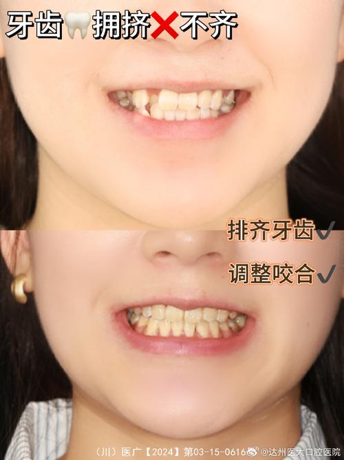 矫正中牙齿不齐？是正常现象还是需调整？-图2