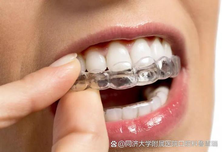 矫正牙齿时，究竟需要拔除哪些牙齿呢？-图2