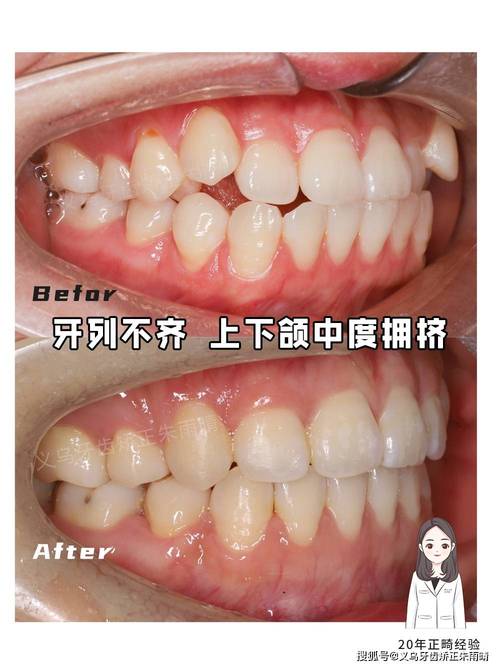 牙齿矫正牙齿不贴合，是什么原因导致的？该如何解决？-图2