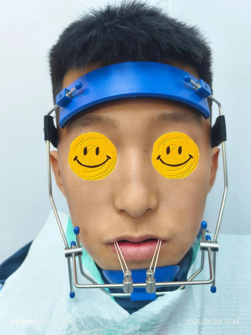 矫正牙齿damon-图1