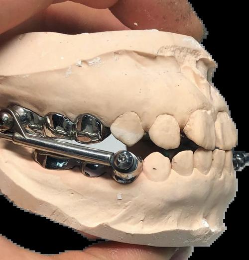 矫正牙齿damon-图3