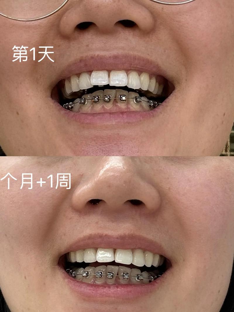 矫正牙齿三个月变化有多大？-图3