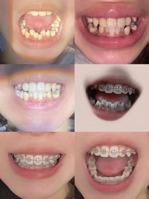 牙齿矫正前后效果图效果如何？变化大不大？-图1