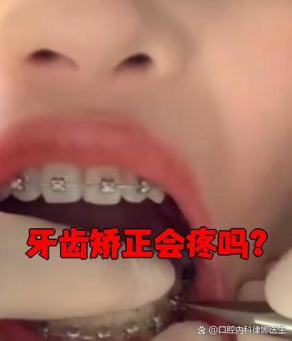 牙齿矫正器刚带很痛-图2