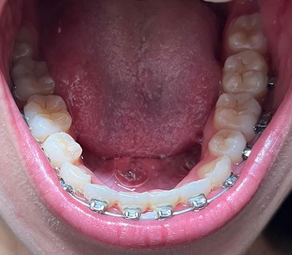 四川省医院矫正牙齿效果如何？价格贵不贵？医生靠谱吗？-图2