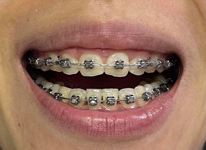 四川省医院矫正牙齿效果如何？价格贵不贵？医生靠谱吗？-图3