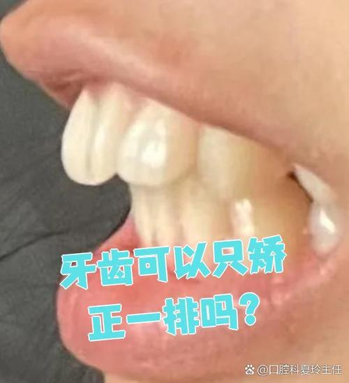 牙齿矫正只矫正一排可行吗？效果会打折扣吗？-图3
