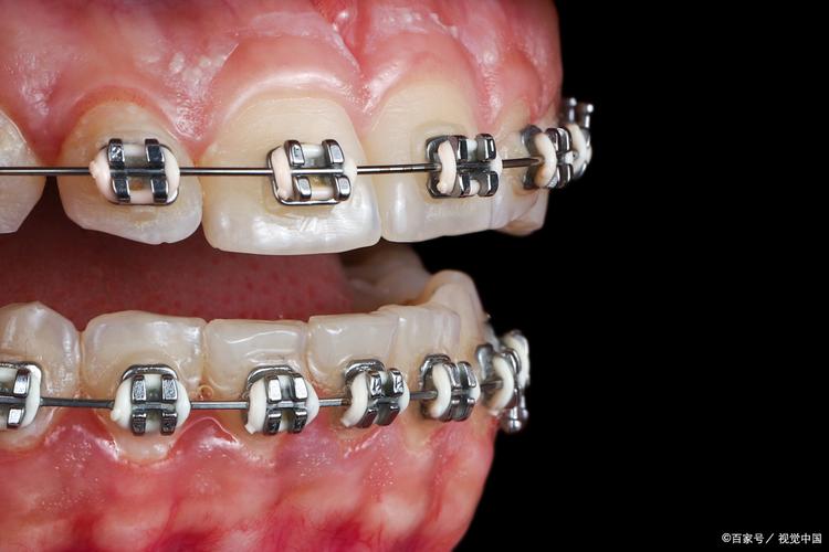 牙齿矫正的一个牙托有何作用？佩戴时会有不适感吗？-图1