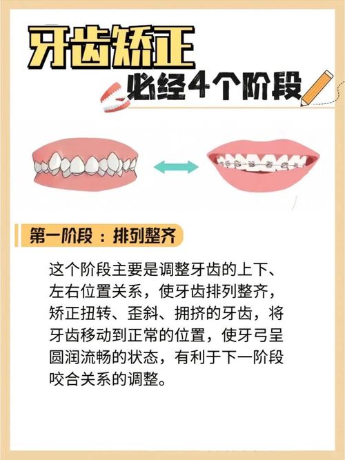 牙齿矫正周期长吗？一般需要多长时间？-图2