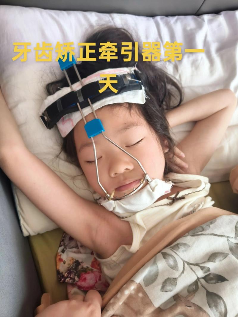 小孩牙齿矫正好不好？家长必知的利弊与注意事项-图1