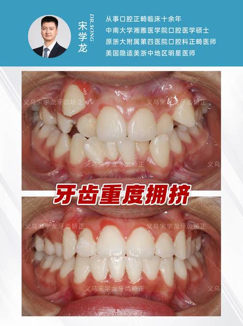 没拔牙矫正牙齿拥挤？效果与方法是否可行？-图2