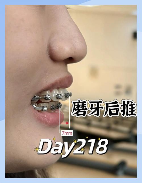 矫正牙齿戴推簧好疼，是正常现象吗？咋缓解呀？-图1