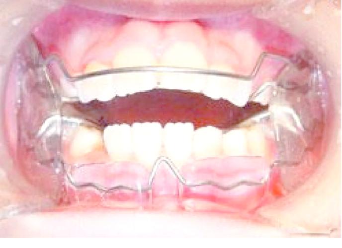 矫正牙齿戴推簧好疼，是正常现象吗？咋缓解呀？-图3