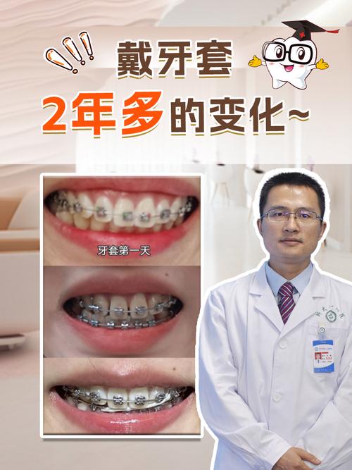 牙齿矫正必须戴牙套吗?还有其他矫正方式可选?-图1 牙齿矫正必须戴牙套吗?还有其他矫正方式可选?-图1