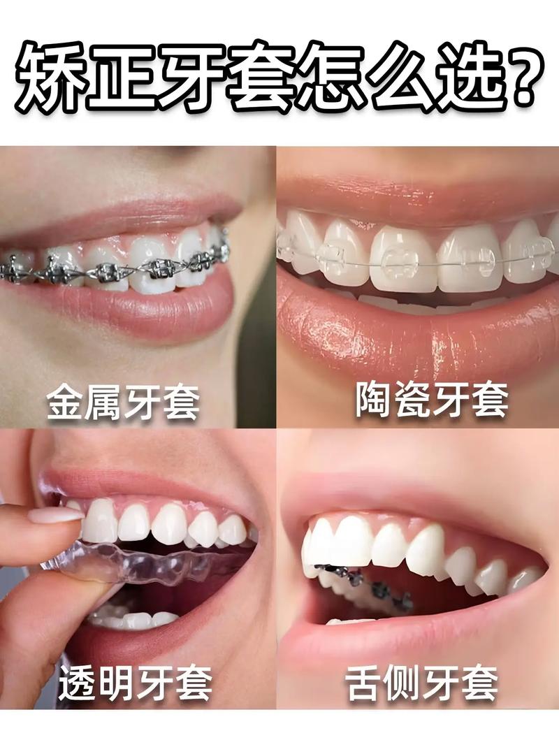 牙齿矫正必须戴牙套吗?还有其他矫正方式可选?-图2 牙齿矫正必须戴牙套吗?还有其他矫正方式可选?-图2