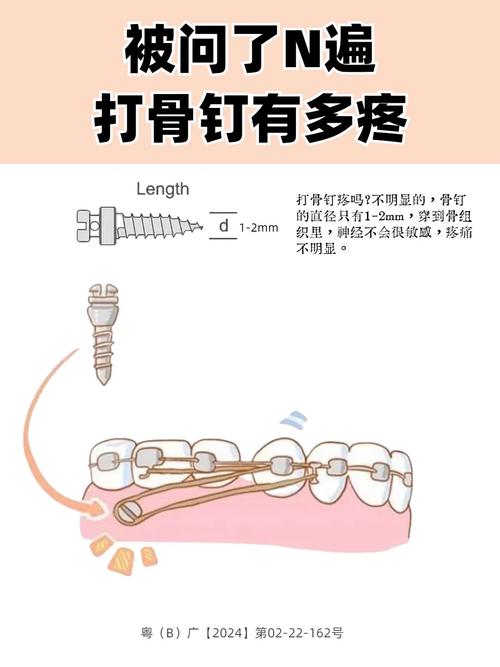 矫正打骨钉疼不疼？牙齿矫正骨钉植入痛感如何？-图1