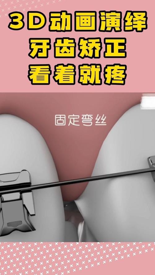 矫正牙齿过程疼吗?疼痛程度如何?-图3 矫正牙齿过程疼吗?疼痛程度如何?-图3