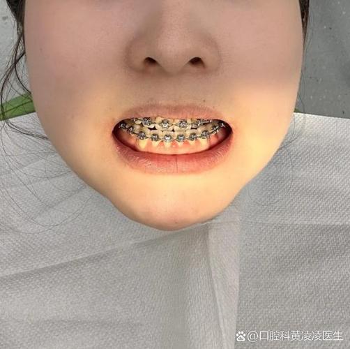牙齿矫正后下巴歪了？是矫正问题还是正常反应？-图1