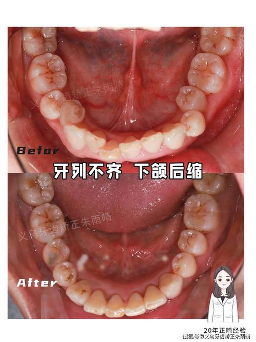 牙齿矫正后下巴歪了？是矫正问题还是正常反应？-图2
