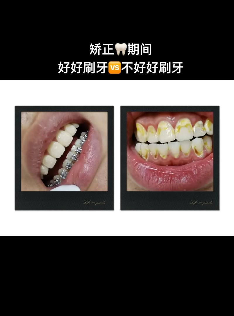 隐形牙齿矫正会有哪些常见后遗症?-图1 隐形牙齿矫正会有哪些常见后遗症?-图1