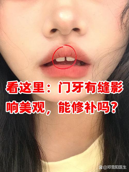 牙齿矫正中门牙为何会有缝隙？-图1