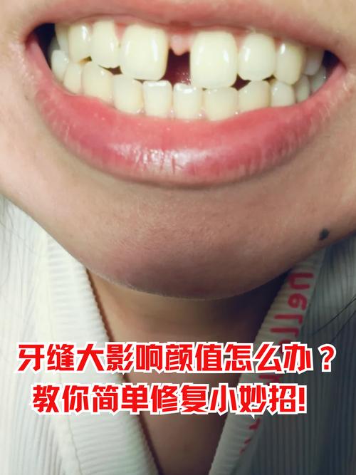 牙齿矫正中门牙为何会有缝隙？-图3