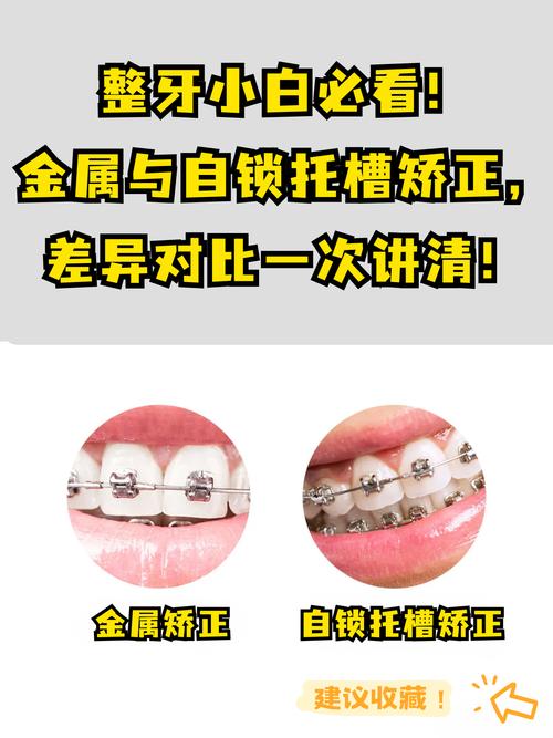 牙齿矫正器是怎么固定在牙齿上的呢？-图1