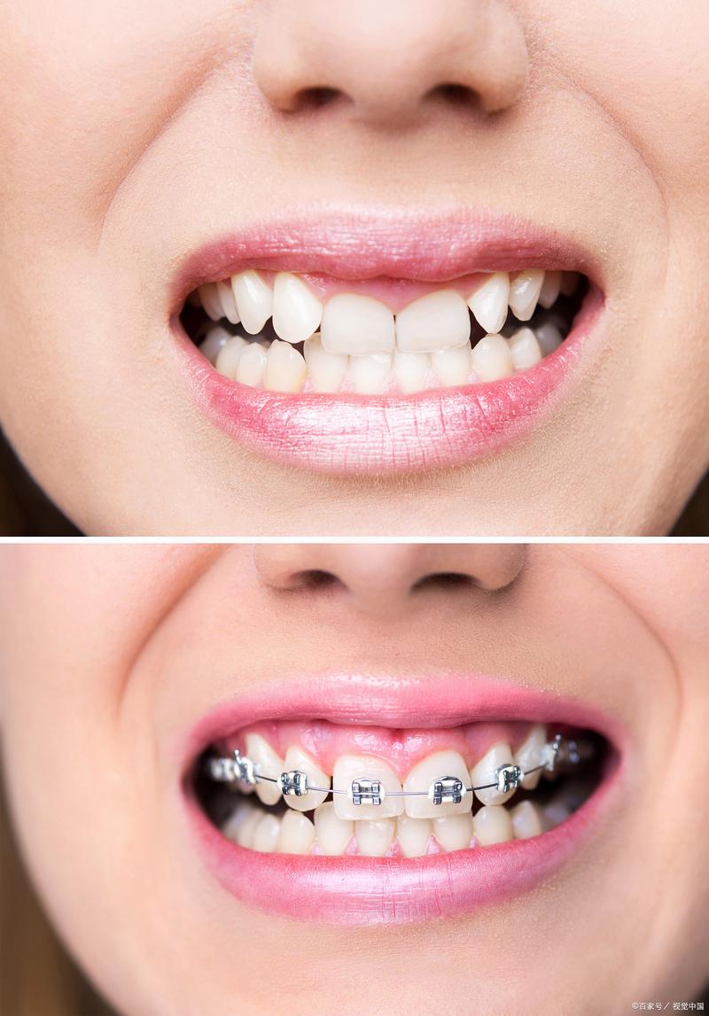 矫正牙齿多少岁最合适？不同年龄段矫正的黄金时间是什么时候？-图1