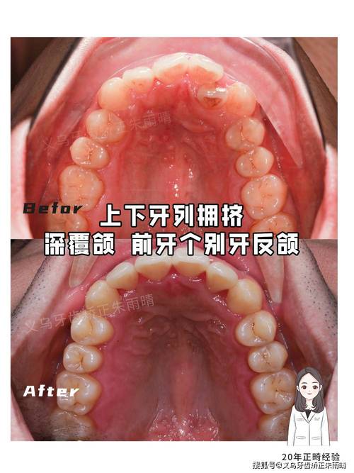 不拔牙矫正牙齿疼吗？矫正过程会痛苦吗？-图2