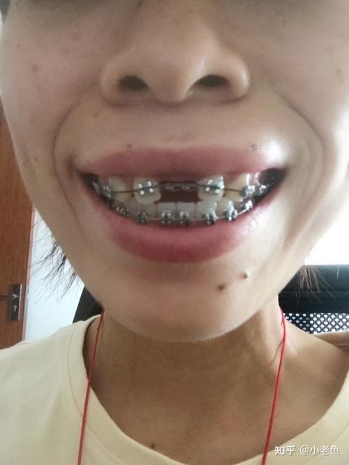 矫正牙齿拔门牙是必须的吗？会有哪些影响？-图3