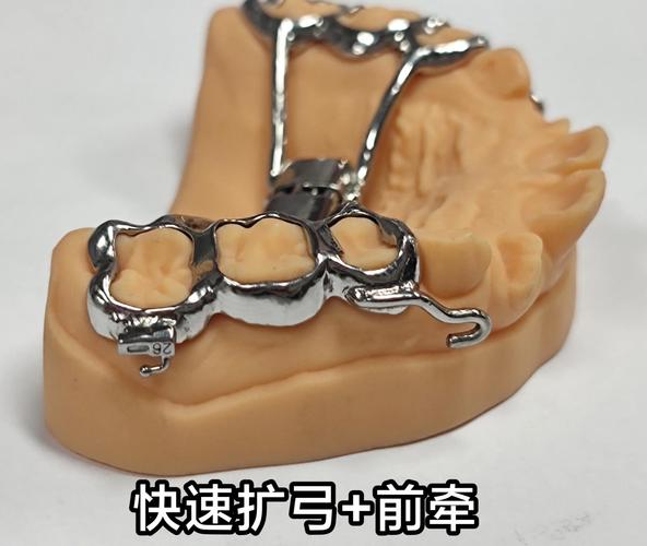 牙齿矫正扩弓是什么?扩弓矫正的原理与作用?-图1 牙齿矫正扩弓是什么?扩弓矫正的原理与作用?-图1